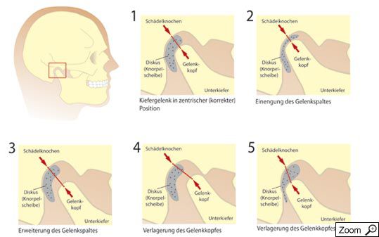 Craniomandibuläre Dysfunktion